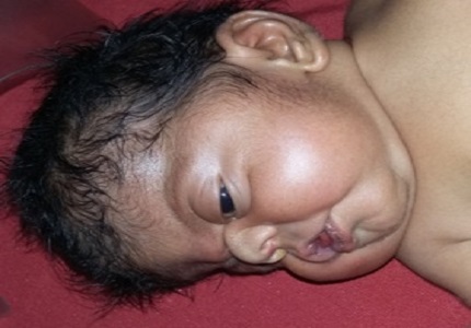 Apert’s Syndrome: rare variant of a common anomaly (Craniosynostosis)