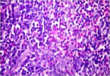 Kimura’s Disease - A Rare Cause of Neck Swelling