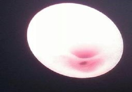 Anterior Urethral Valve- Rare cause of Urethral Obstruction- A case Report