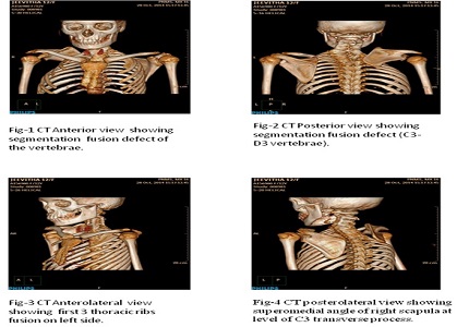 Spondylocostal Dysostosis with Sprengel Deformity: A Rare Association