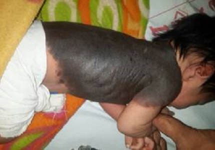 Giant Congenital Melanocytic Nevi: A Case Report and Review of Literature