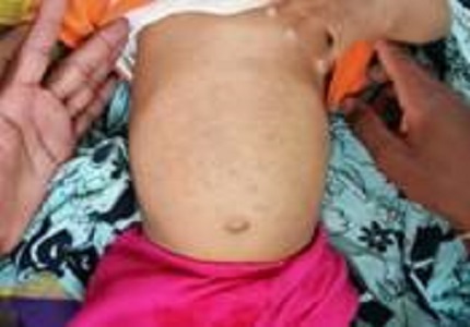 Extensive Mongolian spots: a clinical sign merits special attention for gm1-Gangliosidosis