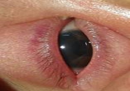 Wolf–Hirschhorn syndrome