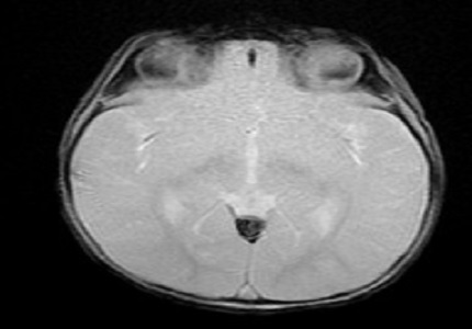 Radiological diagnosis of cerebral venous thrombosis in paediatric age group by Magnetic resonance venography: Pictorial essay
