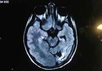 Dyke-Davidoff-Masson syndrome: A case report from South India