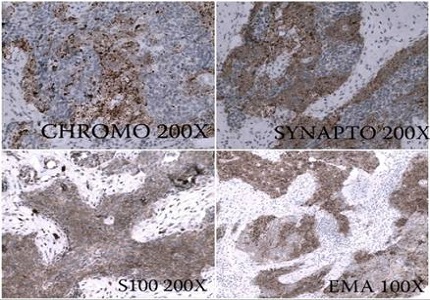Primary small cell carcinoma of oesophagus with syndrome of inappropriate antidiuretic hormone secretion in a young child - a case report with review of literature