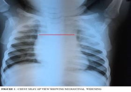Posterior mediastinal neuroblastoma in an infant presenting with paraparesis: a case report