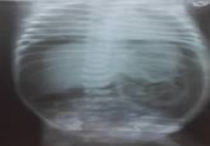 Neonatal Gastric Perforation with Peritonitis- A Rare Case Report