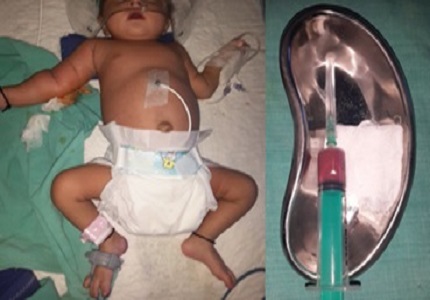 A Case of Post-infectious Disseminated large sized multiple Pneumatoceles secondary to Staphylococcal sepsis