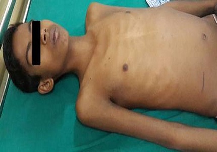 Abdominal tuberculosis presenting as mass per abdomen: a case report