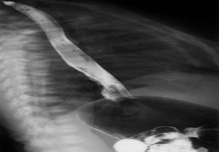 Erosive esophagitis with transient respiratory distress in newborns: a case report
