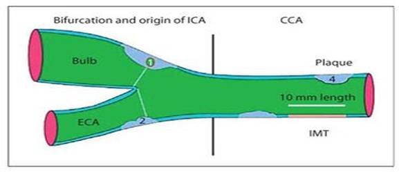 A study on intima- media thickness of carotid artery in children with nephrotic syndrome: a cross sectional study