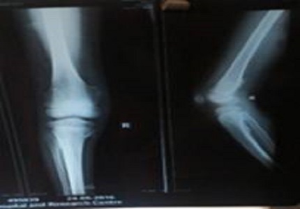 Hereditary multiple exostoses - a rare case
