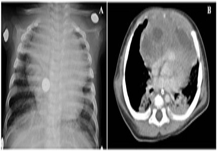 Aches and Pain in a child- An unusual cause