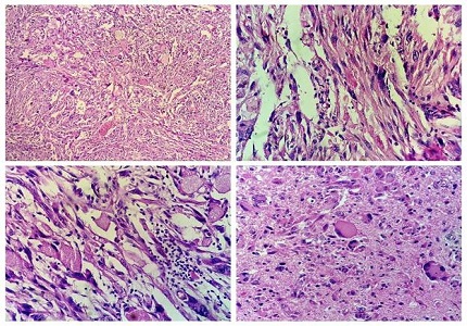 Intra-operative squash cytodiagnosis of pleomorphic xanthoastrocytoma : A diagnostic challenge