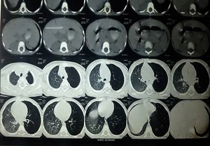 An incidental finding of a vegetative foreign body in left main bronchus in a child presented as wheeze associated respiratory tract infection