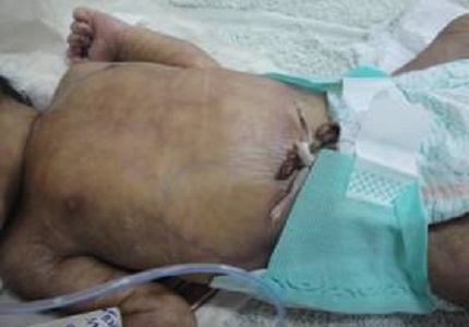 A case of Adams-Oliver Syndrome