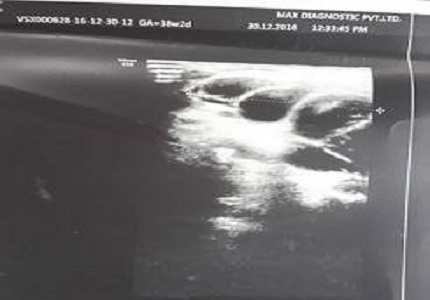 Intralesional bleomycin versus sodium tetradecyl sulphate in the management of peripheral lymphangiomas in children: a prospective comparative study