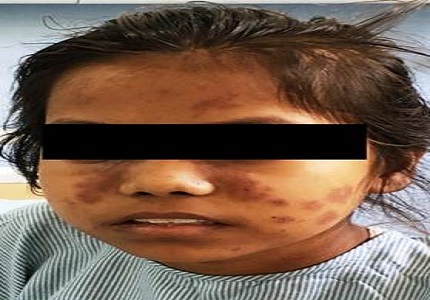 Acute pancreatitis: a rare presentation of systemic lupuserythematous (SLE) in paediatric age group