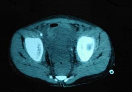 Thirsty Kidneys: Case Report
