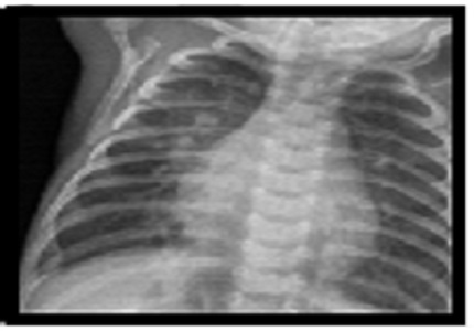 Supramitral congenital mitral stenosis: a rare case
