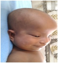 Zellweger Syndrome: A Downs Syndrome Mimic