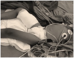 Myocardial abscess – case report of a survivor of a fatal disease