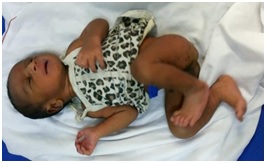 Usefulness of ‘Babkin Reflex’ in normal term Indian infants