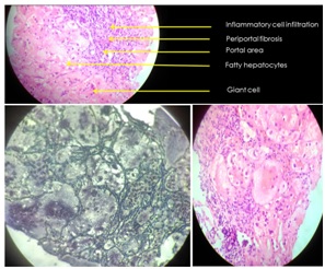 Bile acid synthesis defect (5B-reductase deficiency) a rare cause of cholestasis in an infant
