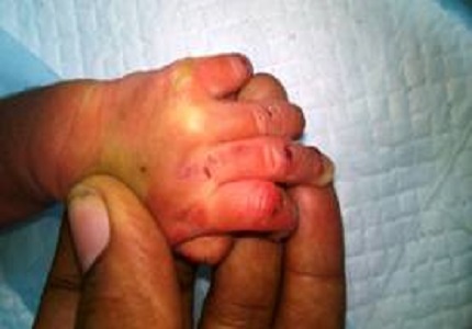 A rare case of bullous congenital ichthyosiform erythroderma in a newborn