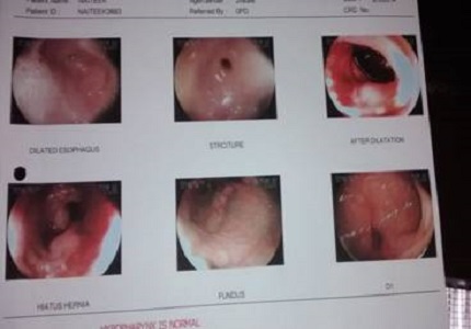 Peptic Esophageal Stricture in children: A Case report & review of literature