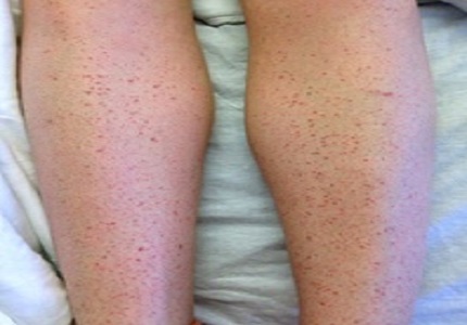 Type II hypersensitivity and trimethoprim-sulfamethoxazole