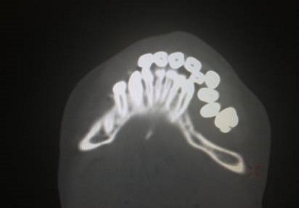 Bilateral TMJ ankylosis, anesthetic and surgical challenge- case report